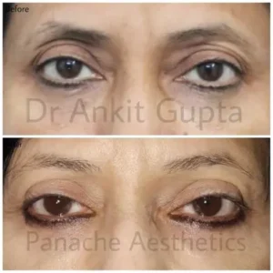 undereye dark circle 6