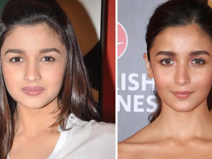 Alia Bhatt plastic surgery actress plastic surgery before after buccal fat removal