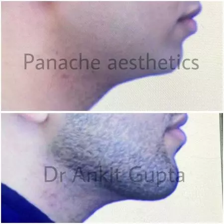 chin implants for jawline reation. Plastic Surgery transformation of indian male.