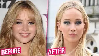actress plastic surgery before after buccal fat removal actress plastic surgery before after buccal fat removal