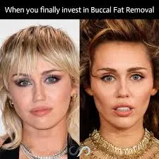 actress plastic surgery before after buccal fat removal3 actress plastic surgery before after buccal fat removal