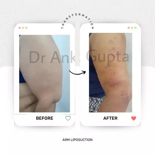 ARM LIPOSUCTION Arm lipo surgery before and after