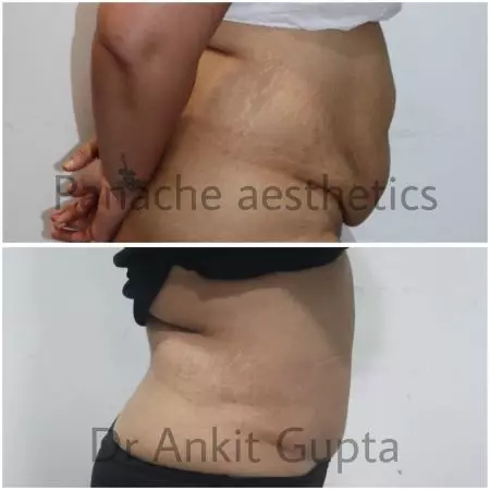 tummy tuck for diastasis recti 1 diastasis recti or abdominal separation correction treatment