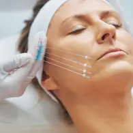 thread lift